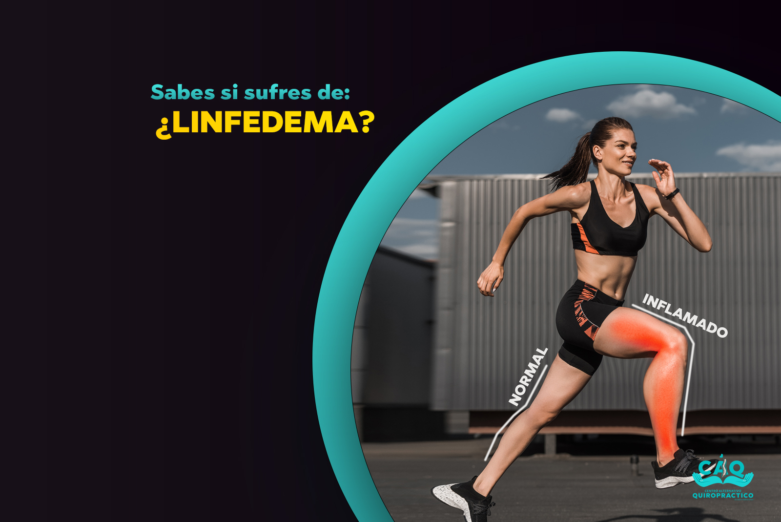 Imagen destacada de Linfedemia - Centro alternativo quiropractico - 2