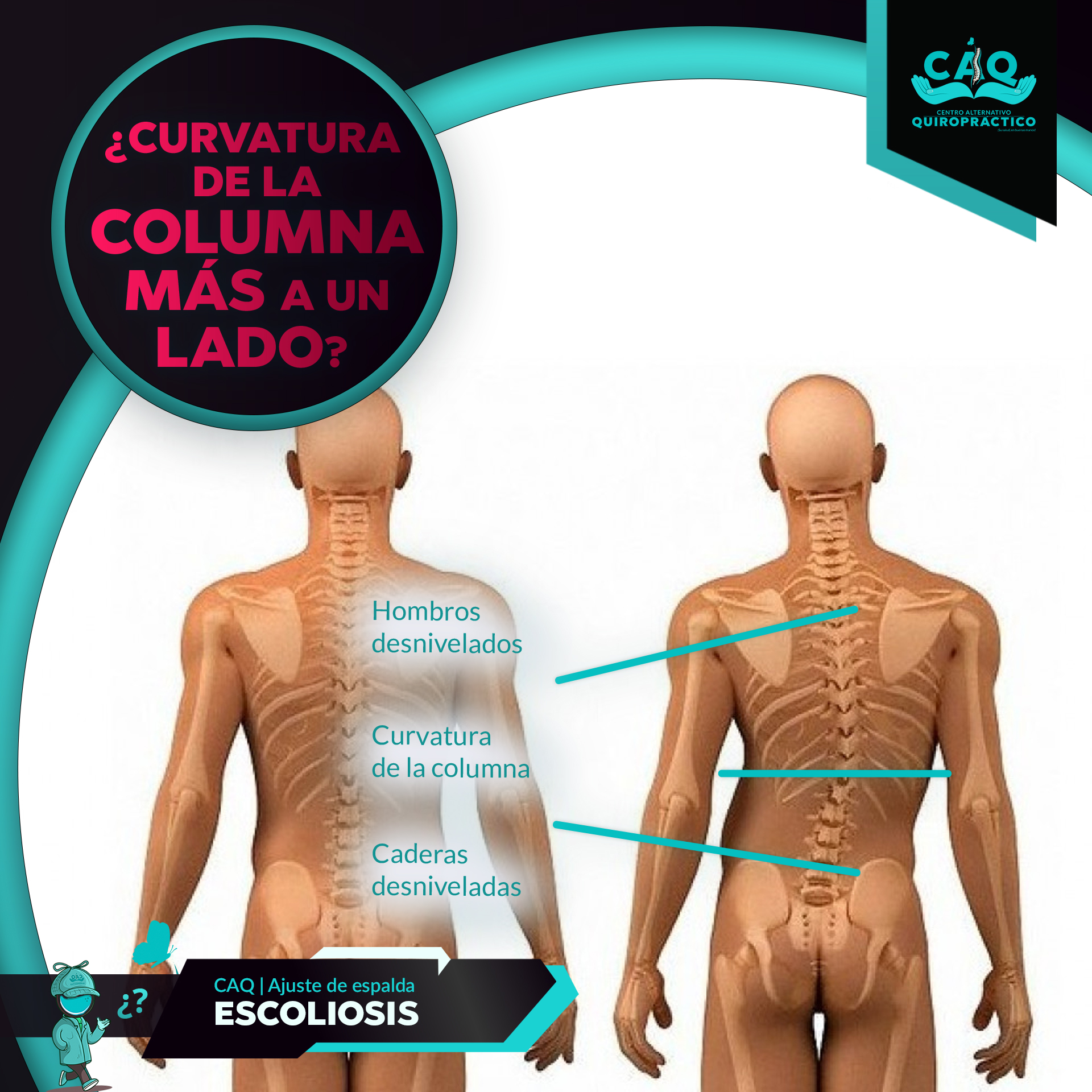 Escoliosis - Centro Alternativo Quiropractico - 3