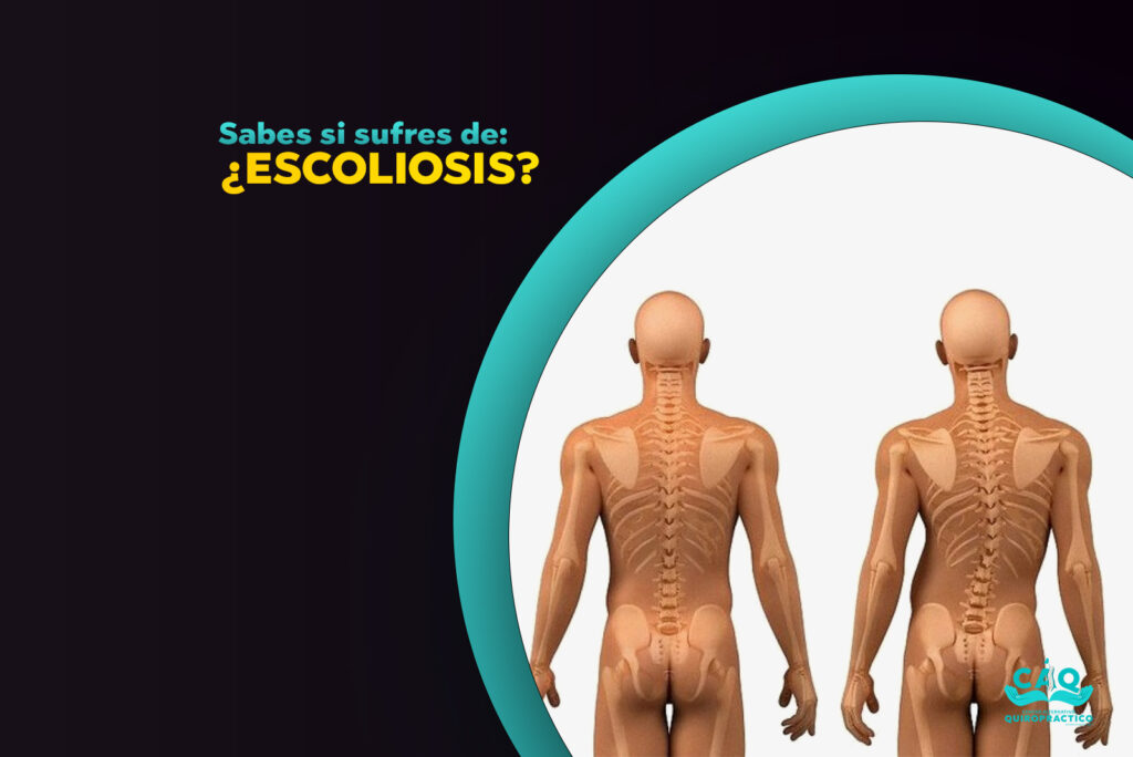 Imagen destacada de Escoliosis - Centro alternativo quiropractico - 2